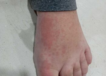 Sobe para 137 o número de casos de febre do maruim em SC