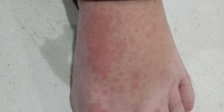 Sobe para 137 o número de casos de febre do maruim em SC